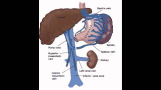 Distal Splenorenal Shunt  Presentation [upl. by Pearlman]