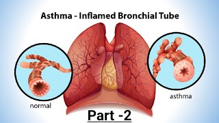 AsthmaPart2Unit5Pulmonary NursingAHNII Bsn 4rth Semester inEnglish [upl. by Melliw]