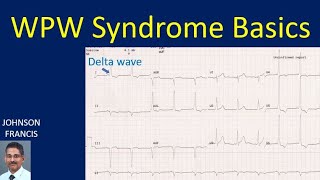 WPW Syndrome Basics [upl. by Atkins918]