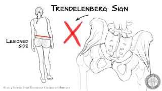 The Trendelenberg Sign HD [upl. by Richara]