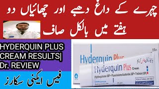 Hyderquin plus cream uses Melasma Hyperpigmentation freckle and acne scar treatment formula cream [upl. by Algernon263]