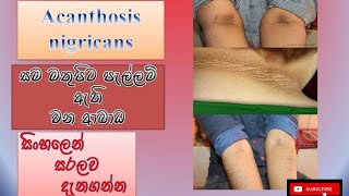 Acanthosis nigricansසමමත පැල්ලම් ආශ්‍රිත රෝගcauseshow it happenstreatmentsinhalahow to prevent [upl. by Enrev]