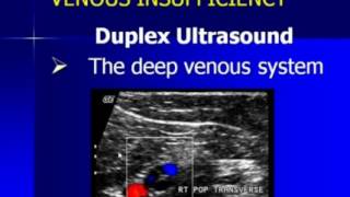 Lower Extremity Venous Duplex Ultrasound Chronic Venous Insufficiency [upl. by Neelya799]