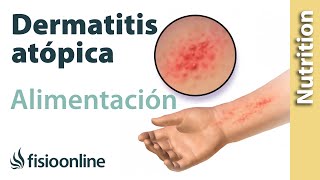 Importancia de la nutrición en el desarrollo en la dermatitis atópica [upl. by Tsepmet]