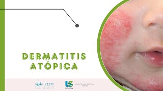 DERMATITIS ATOPICA [upl. by Byler]