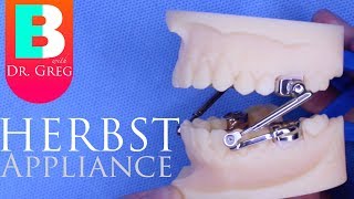 BRACES EXPLAINED Herbst Appliance [upl. by Timmie967]