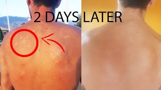 How I cured Tinea Versicolor in 2 days forever [upl. by Jamille]