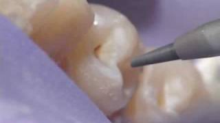 Dental Air Abrasion  Denville NJ [upl. by Deina]