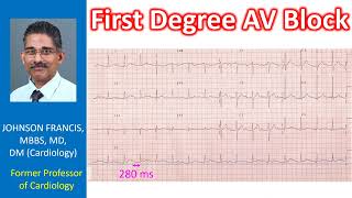 First Degree AV Block [upl. by Erikson]