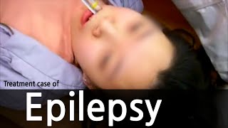 Treatment case of epilepsy  간질 뇌전증 치료사례 [upl. by Renfred543]