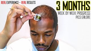 Microneedling Hair Regrowth Results 3 Months  Month by Month Progress [upl. by Adnorrahs]