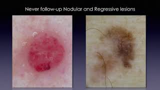 Changing lesions during followup  Dr Elvira Moscarella [upl. by Bamberger989]