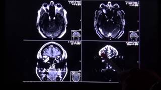 thyroid opthalmopathy in T2 and STIR mri sequence by Radiologie TV [upl. by Rodavlas]