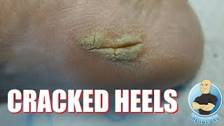 HOW TO GET RID OF CRACKED HEELS  FULL TREATMENT [upl. by Uhn]