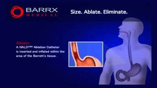 BARRX Medical HALO360 ablation technology [upl. by Poul936]