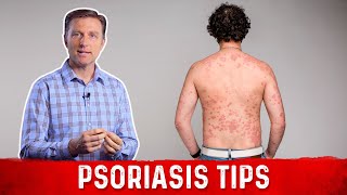 How to Get Rid of Psoriasis – Natural Remedies for Psoriasis by DrBerg [upl. by Dewitt]