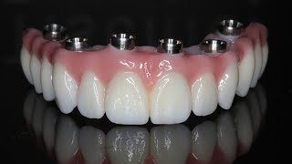 Qual o Preço de Uma Prótese Dentária de Protocolo Quanto Custa uma Prótese Dentaria Implantada [upl. by Ailido247]