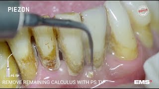 Guided Biofilm Therapy Step 06 Calculus removal with PIEZON® and the PS instrument [upl. by Atselec]