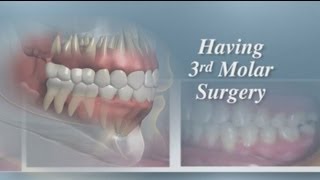 Having Third Molar Surgery [upl. by Kcirdorb]