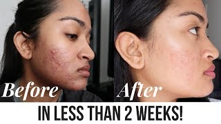 Acne Treatment Facial Peel  Before and After  SilasQiu [upl. by Sauder771]