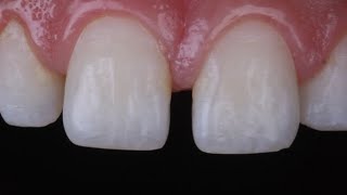 diastema closure with composite resin [upl. by Oinesra]