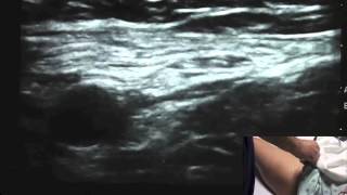 Ultrasound Guided Femoral Nerve Block  SSRAUSAcom [upl. by Herbert909]