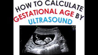 HOW TO CALCULATE GESTATIONAL AGE AND EDD DUE DATE BY ULTRASOUND DATING SCAN SECOND TRIMESTER SCAN [upl. by Krawczyk693]