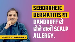 Seborrheic dermatitis या Dandruff से होने वाली scalp allergy Dr sandesh Gupta 9990804085 [upl. by Jasmina546]