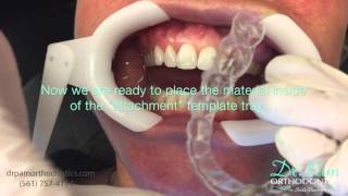 Starting Invisalign Treatment Placing Attachments and Fitting Tray 1 [upl. by Estrella]