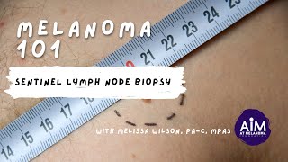 Sentinel Lymph Node Biopsy [upl. by Ordnael]