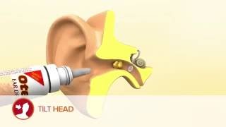 How to use Otex Ear Drops [upl. by Leber]