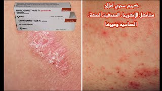 كريم سحري لعلاج مشاكل الأكزيماالصدفيةالحكةالحساسيةوغيرها diprosone 4k [upl. by Gavrilla791]