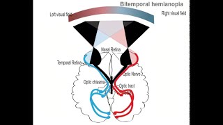 Lesion at the Optic chiasma and Bitemporal Heteronymous Hemianopia [upl. by Baldwin621]