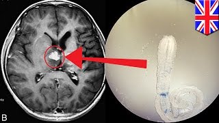 Tapeworm infection Rare brain worm took 4 years to crawl across UK man’s brain [upl. by Patnode]