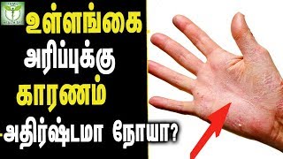 Peeling Skin on hands Treatment  Tamil Health amp Beauty Tips [upl. by Kym]