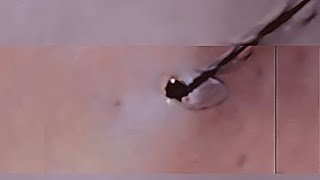 Removal of ingrown hair [upl. by Latsyek]