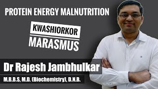 PROTEIN ENERGY MALNUTRITION PEM Kwashiorkor and Marasmus [upl. by Malka]