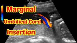 Marginal Umbilical Cord Insertion [upl. by Coppins]