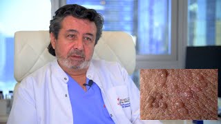 Best Warts Removal With Laser Treatment and kills the HPV virus [upl. by Luy]