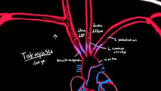 Takayasu Arteritis [upl. by Aicala]