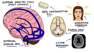 Cerebral Venous Sinus Thrombosis CVST  With Dural Venous Sinuses Anatomy [upl. by Nowtna]