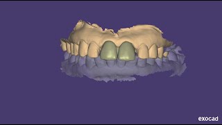 Upper anterior Tooth supported crown designing in exocad [upl. by Nabe]