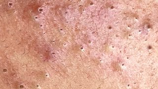 Big Cystic Acne Blackheads Extraction Blackheads amp Milia Whiteheads Removal Pimple Popping 0037💆 [upl. by Epuladaugairam]