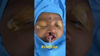 BEST Cleft Lip Plastic Surgery At Richardsons Face Hospital [upl. by Odille]