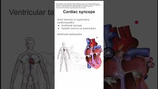 Cardiac syncope [upl. by Ruhtra]