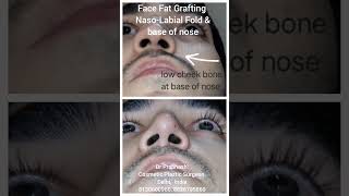 Face Nose Cheek Fat Grafting Asymmetry Correction in Delhi fatgraftingsurgery  nose  nosetip [upl. by Anerec]