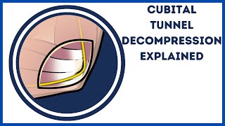 Cubital Tunel Decompression  Ulnar Nerve Release Explained [upl. by Ahsienat]