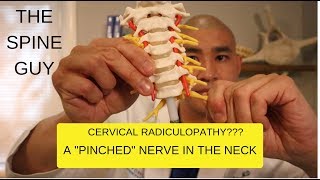 CERVICAL STENOSIS RADICULOPATHY PART 1  SYMPTOMS IMAGING AND PATIENT EXAM [upl. by Kirby]