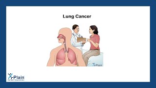 Lung Cancer [upl. by Netneuq]