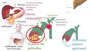 Cholecystitis Signs and symptoms Chronic and acute Cholecystitis biliary colic [upl. by Christabelle]